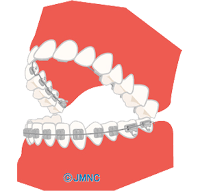 ハーフリンガル