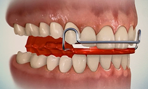 自宅で装着する装置